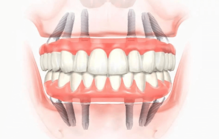 Подробней об имплантации зубов Все на 6