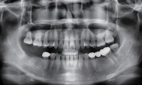 Объемный 3D снимок всей челюсти