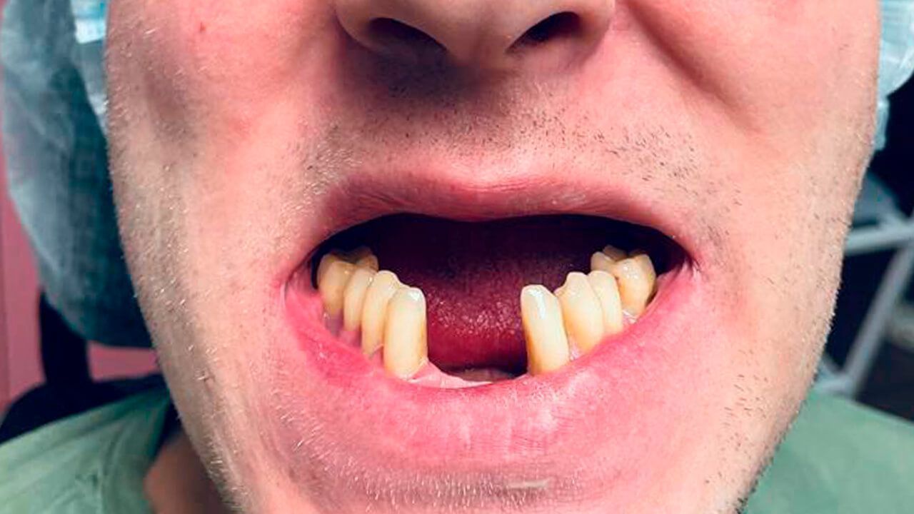 Отсутствие передних зубов нижней челюсти и полная адентия верхней челюсти