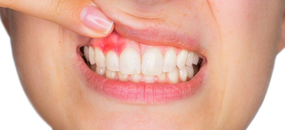 parodont-inflammation-the-periodontal-seocka.jpg