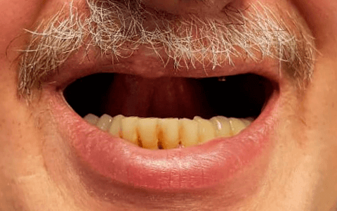 Отсутствие зубов верхней челюсти