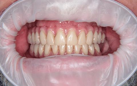 Вернули зубы не обе челюсти методом имплантации All-on-6