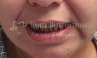 Восстановление зубов верхней и нижней челюсти - Фотография 1