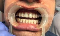 Восстановление зубов на двух челюстях при парадонтозе - Фотография 2