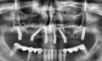 Восстановление зубов на верхней челюсти - Фотография 2