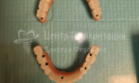 Имплантация зубов Все-на-6 на верхней и нижней челюсти - Фотография 3