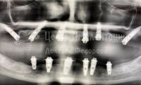 Имплантация зубов - Фотография 4