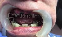Восстановление всех зубов  - Фотография 1