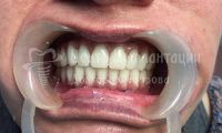 Восстановление всех зубов  - Фотография 2
