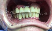 Восстановление зубов за 2 дня - Фотография 1