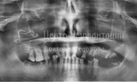 Восстановление зубов на верхней челюсти при пародонтозе - Фотография 1