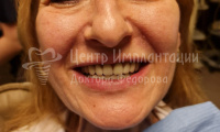 Имплантация зубов Все-на-6 на верхней и нижней челюсти - Фотография 2